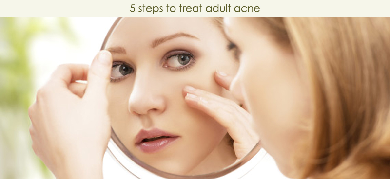 5 Steps To Treat Adult Acne